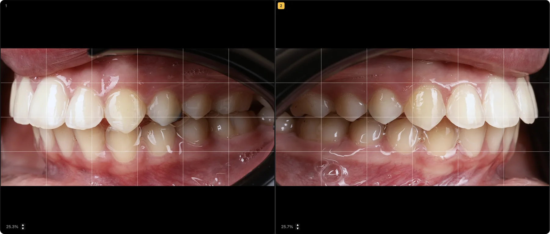 Deux vues d'occlusion latérale cadrées à l'identique dans le logiciel U-SHOOT, avec grille de composition, reproductibilité en photographie dentaire